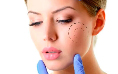 Bichectomía para un contorno facial perfecto