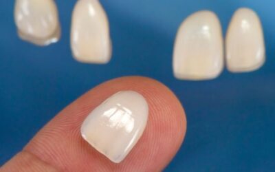 Consigue la sonrisa perfecta con las carillas dentales