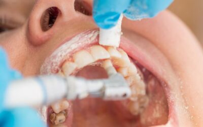 Todo lo que debes saber sobre la limpieza dental
