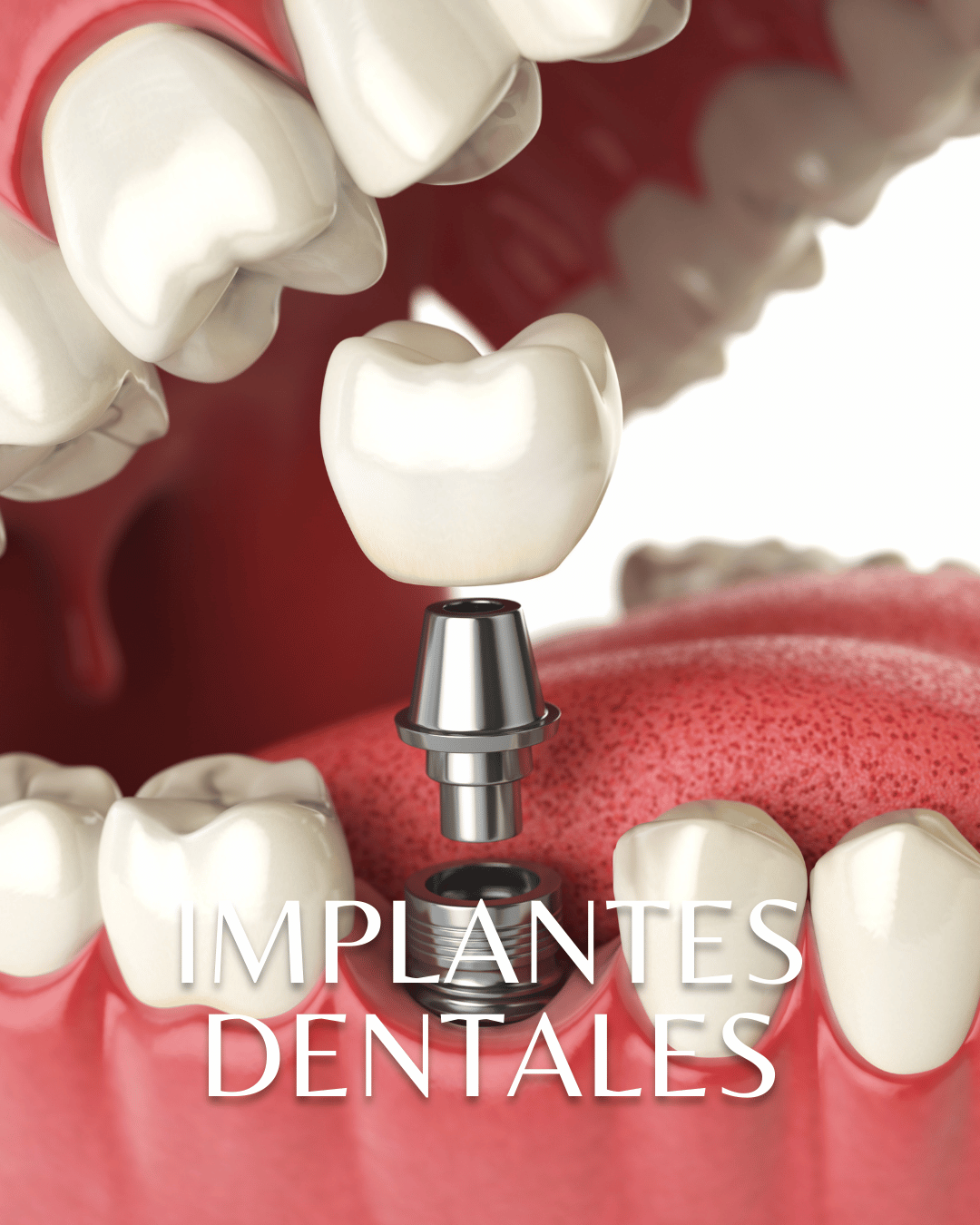 Implantes dentales