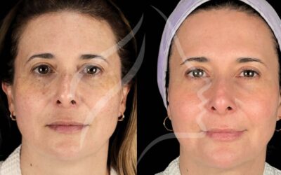 Cosmelan peel