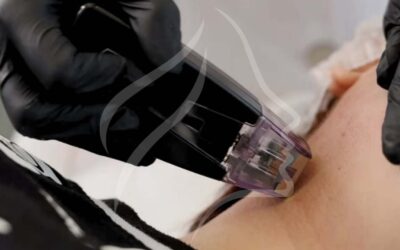 Morpheus 8 y bioestimuladores