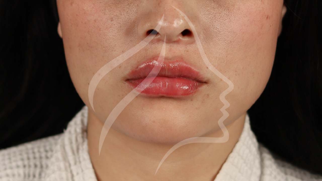 skinbooster