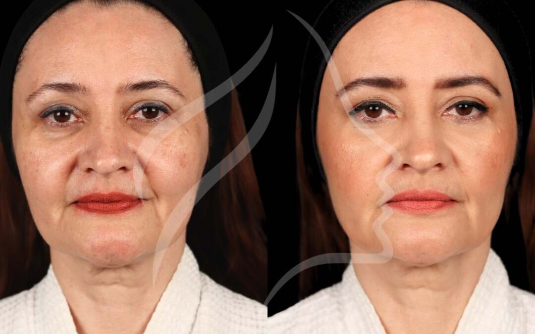 Ultherapy