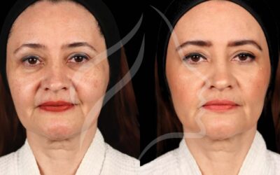 Ultherapy