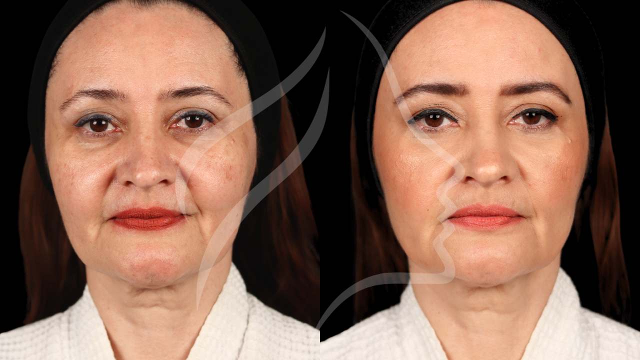 Ultherapy